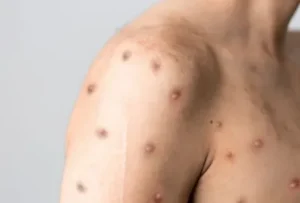 Mpox chega a 81 casos no Brasil este ano; veja sintomas e quando suspeitar