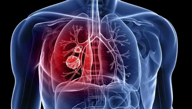 Comitê vai acompanhar encomenda tecnológica para teste portátil de tuberculose — Agência Gov