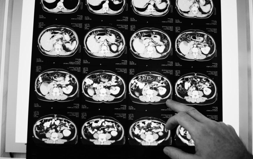 Anvisa aprova novo medicamento para câncer colorretal metastático — Agência Gov